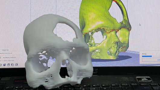 Печатают 3D черепа и кости. Кировские хирурги рассказали, как 3D-принтер помогает спасать жизни
