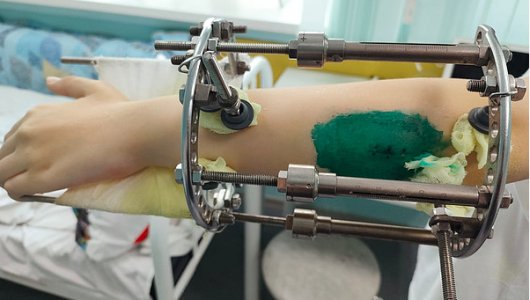 13-летней кировчанке спасли руку. Кировские врачи вылечили девочку, которая страдала от недуга 9 лет.