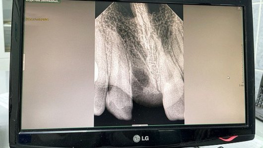Стоматологи помогли 13-летней девочке установить на место выбитый зуб
