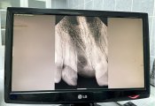 Стоматологи помогли 13-летней девочке установить на место выбитый зуб