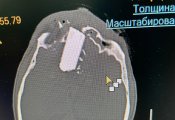 Кировские врачи достали из головы чепчанина 6-сантиметровый осколок диска